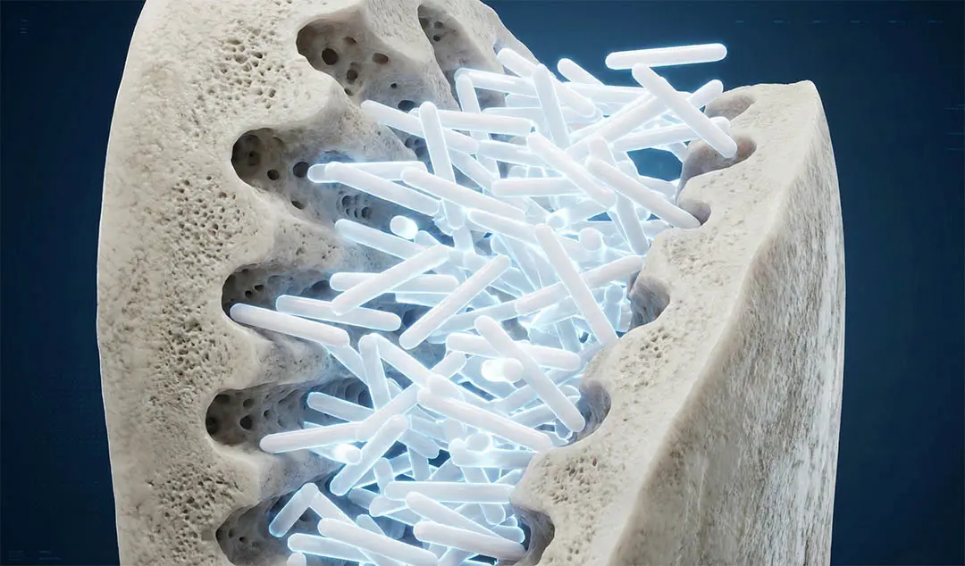 Schéma montrant la technologie d'occlusion des tubules dentinaires pour le soulagement de la sensibilité