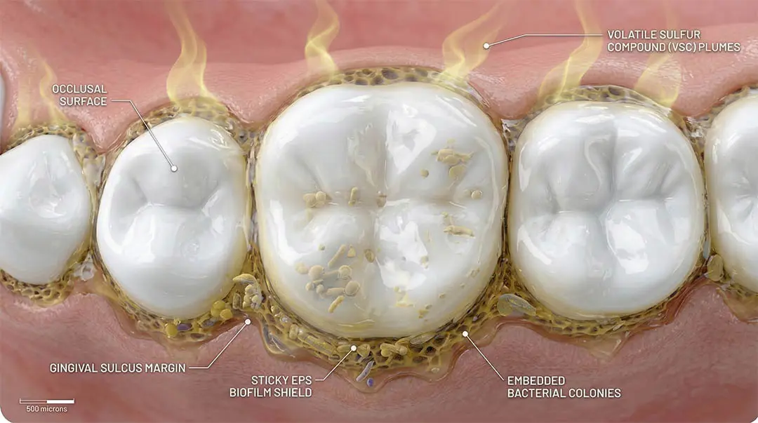 Diagramme montrant le Piège Sous-Gingival et le Biofilm EPS
