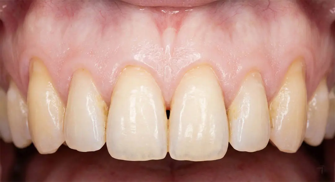 Macro-Image Clinique du Traitement de la Récession Gingivale