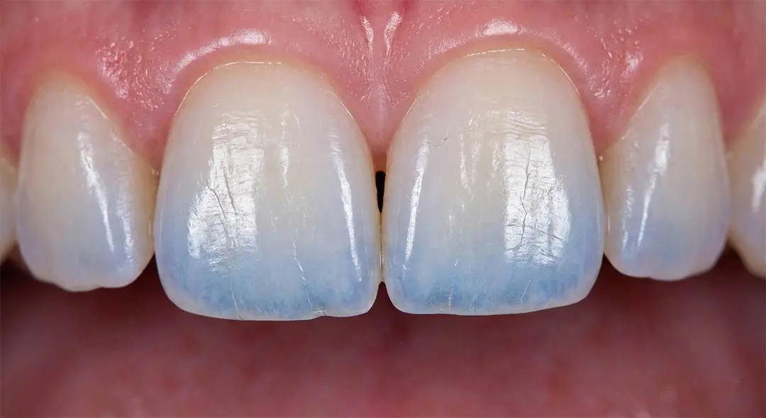 Macro-Image Clinique de la Réparation de l'Émail Translucide