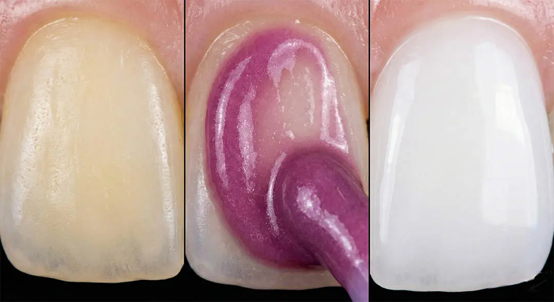 Avant et après neutralisation de l'émail dentaire - Blanchiment Optique